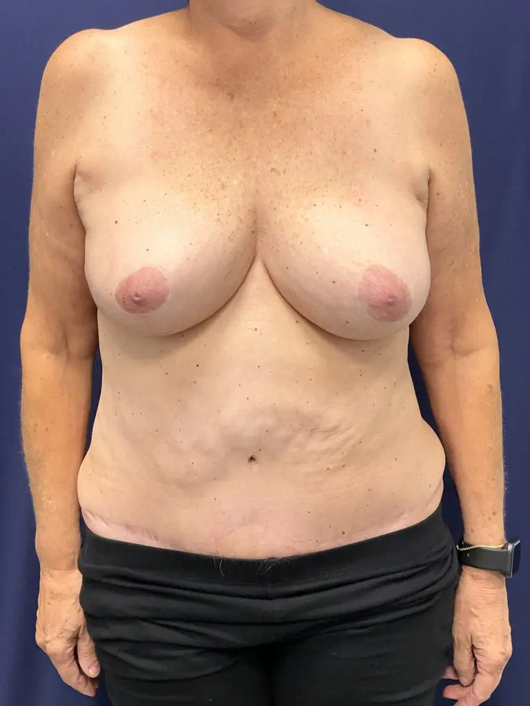 Abdominoplasty - Case 4719 - After