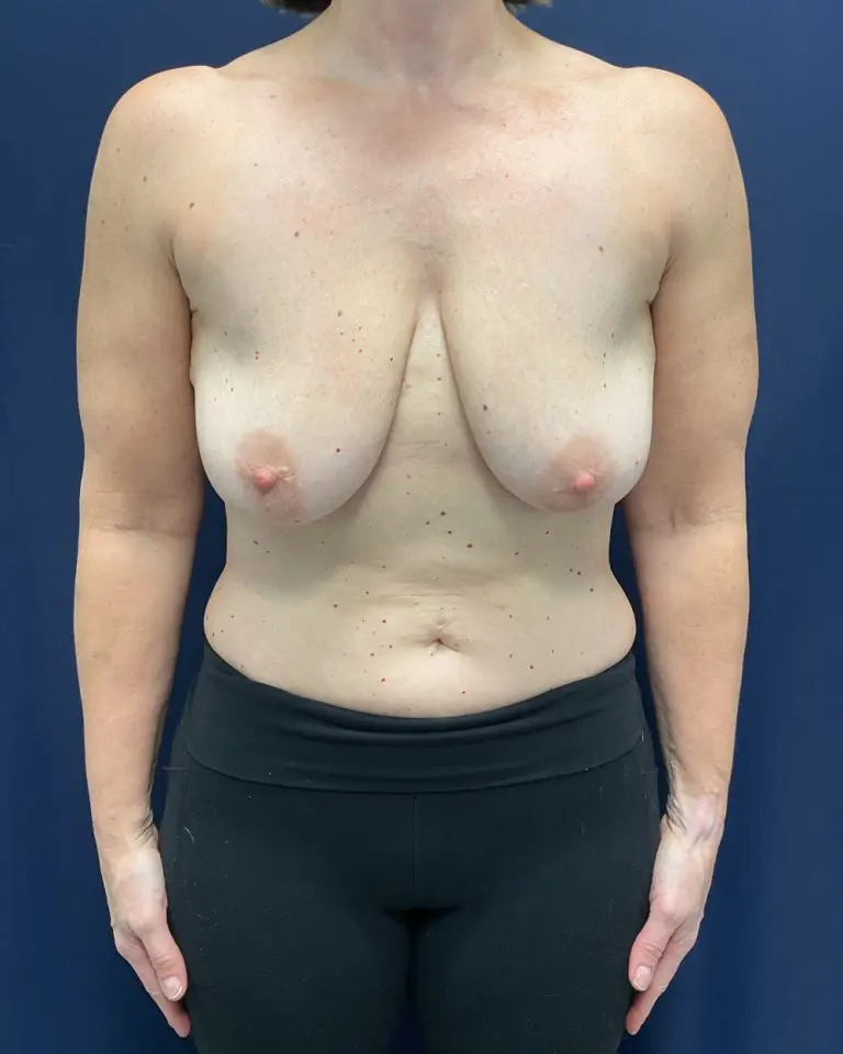 Breast Lift - Case 5188 - Before