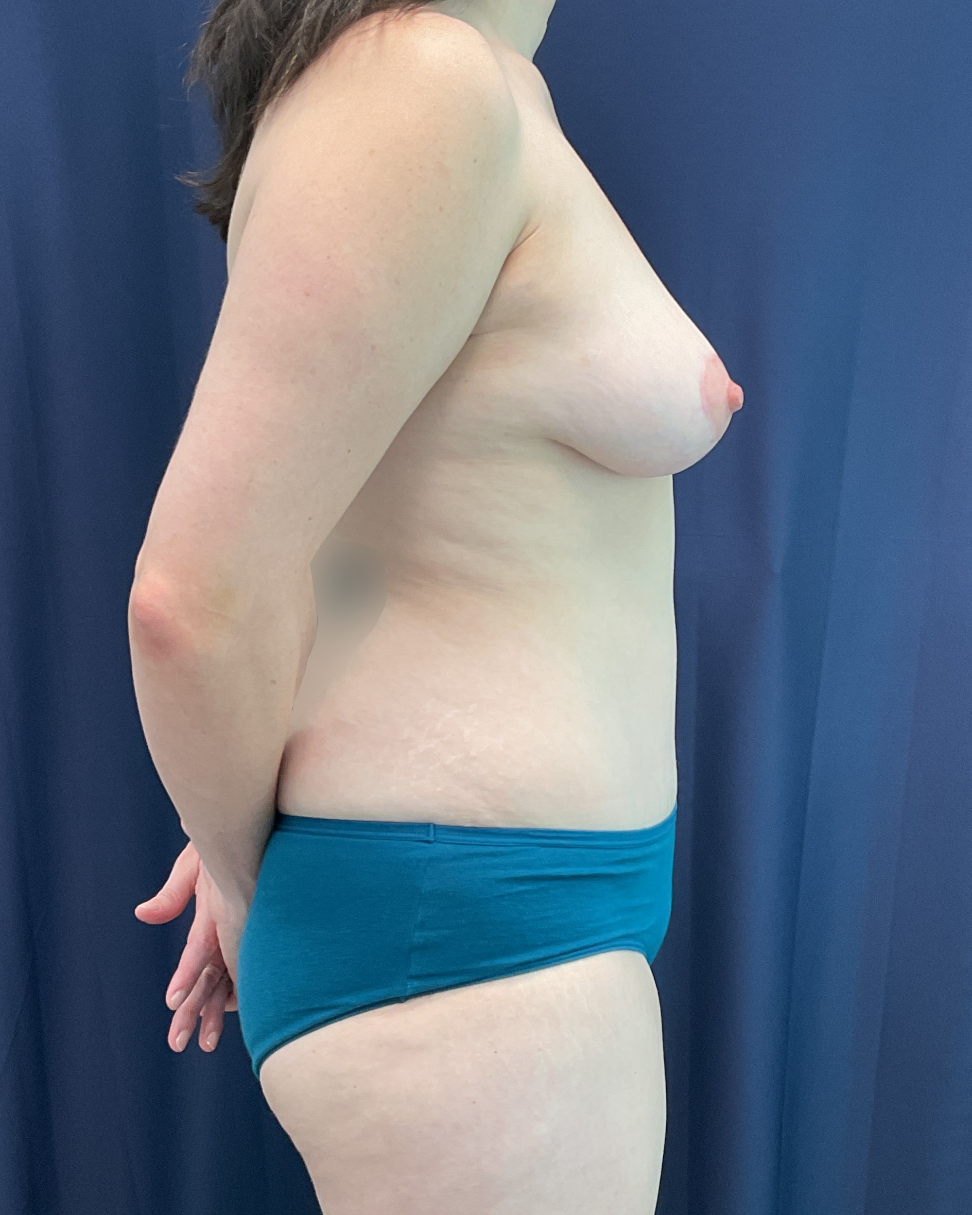 Abdominoplasty Patient Photo - Case 5460 - after view-4