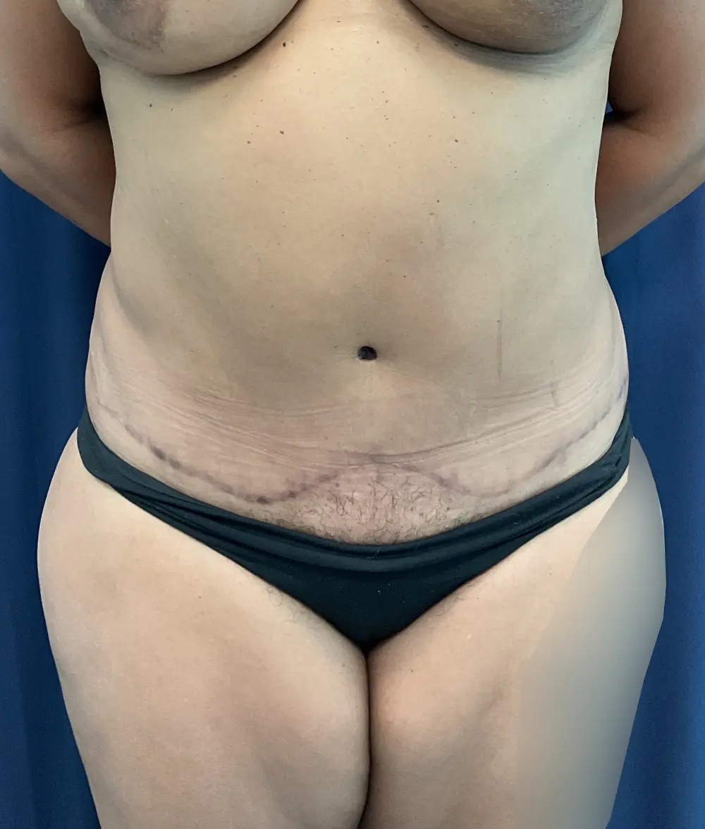 Abdominoplasty Patient Photo - Case 5706 - after view