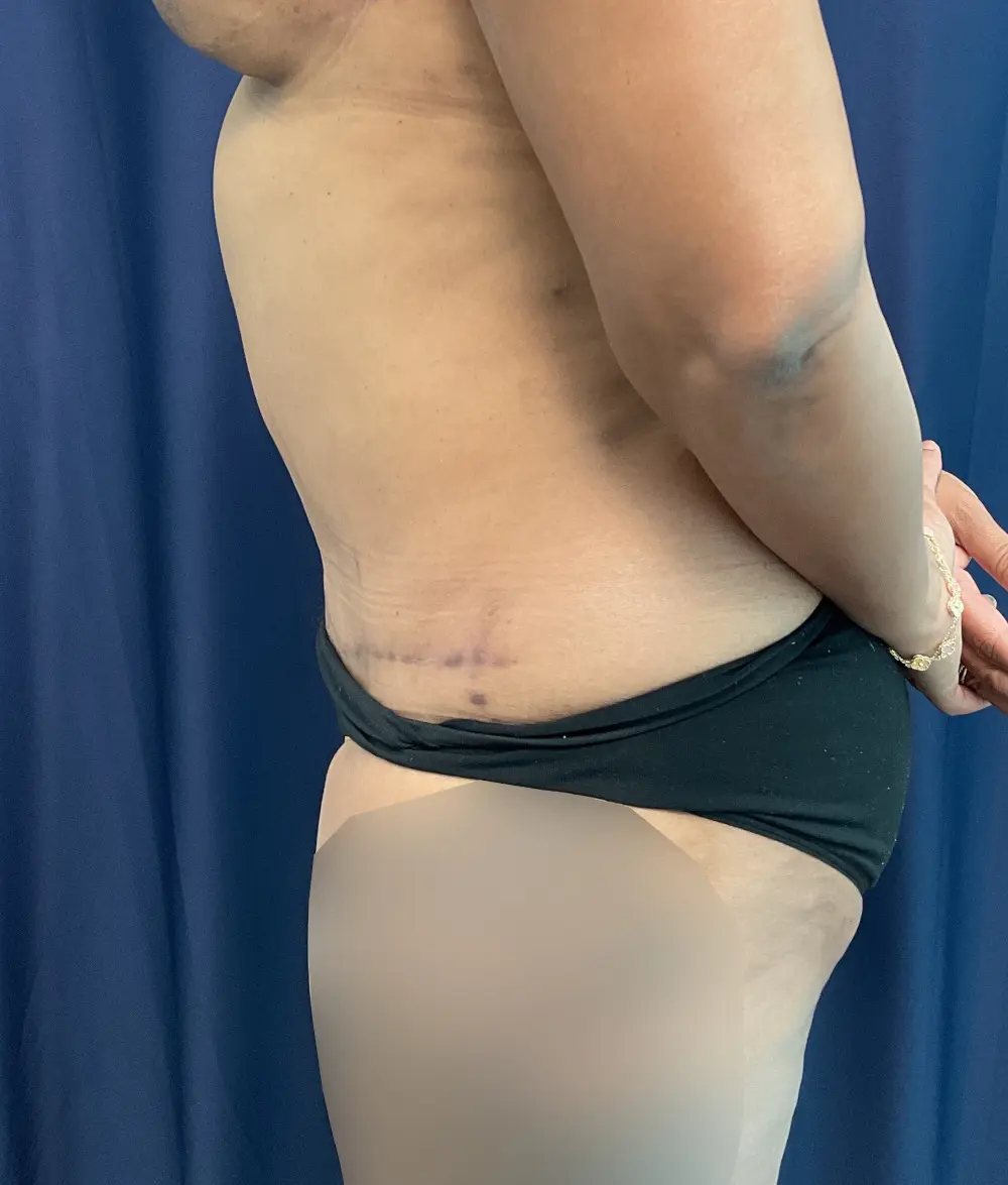 Abdominoplasty Patient Photo - Case 5706 - after view-2