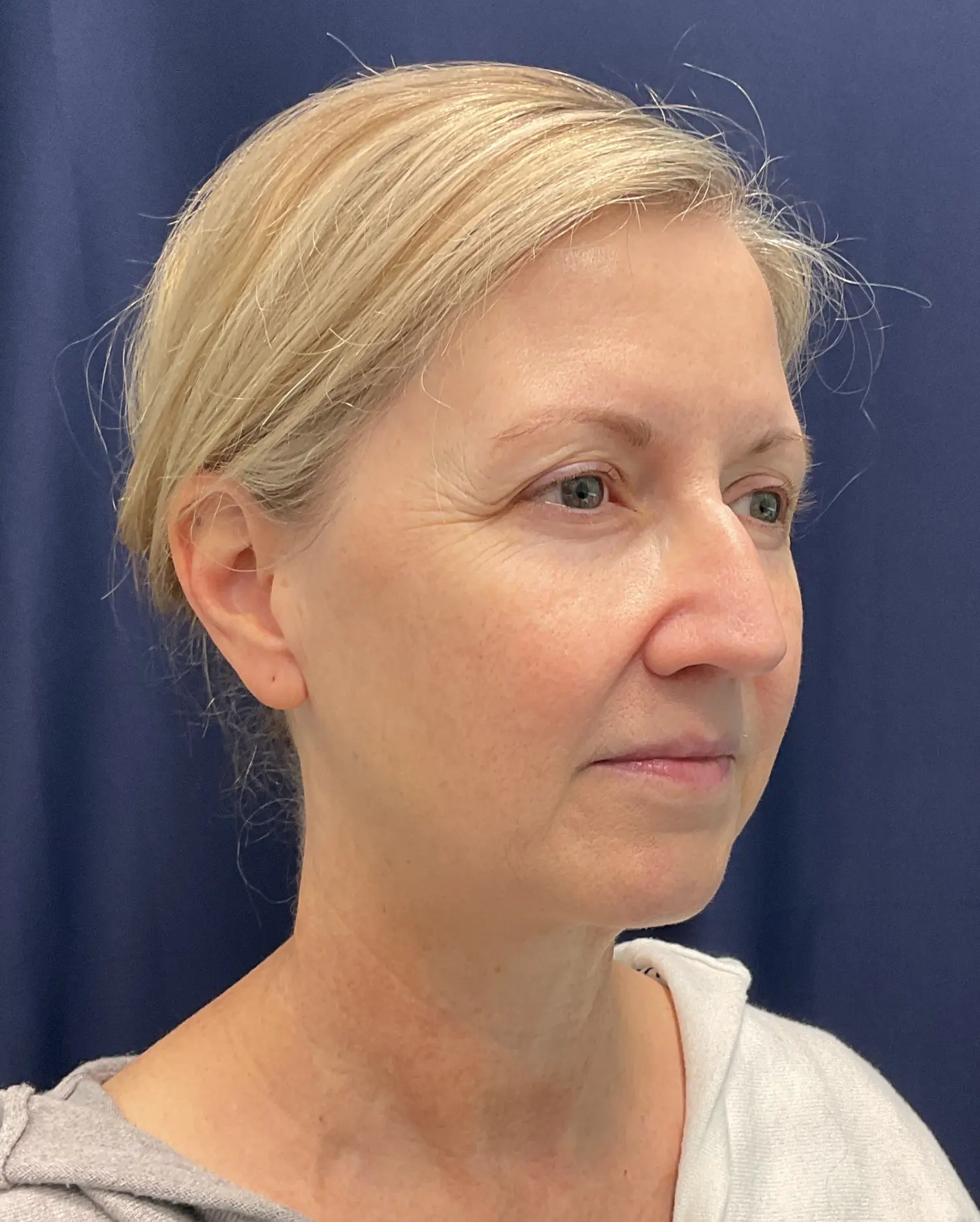 Eyelid Surgery Patient Photo - Case 5831 - before view-1
