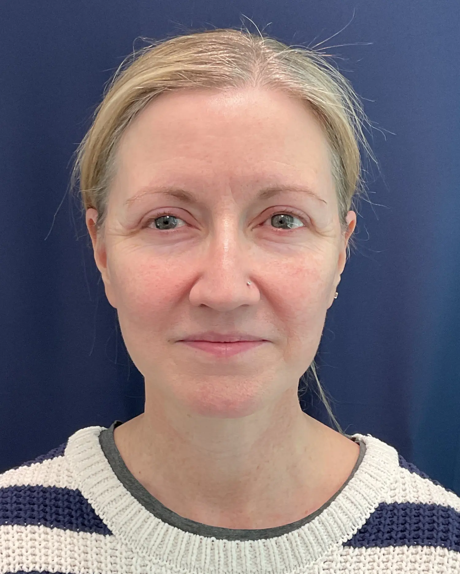 Eyelid Surgery Patient Photo - Case 5831 - after view