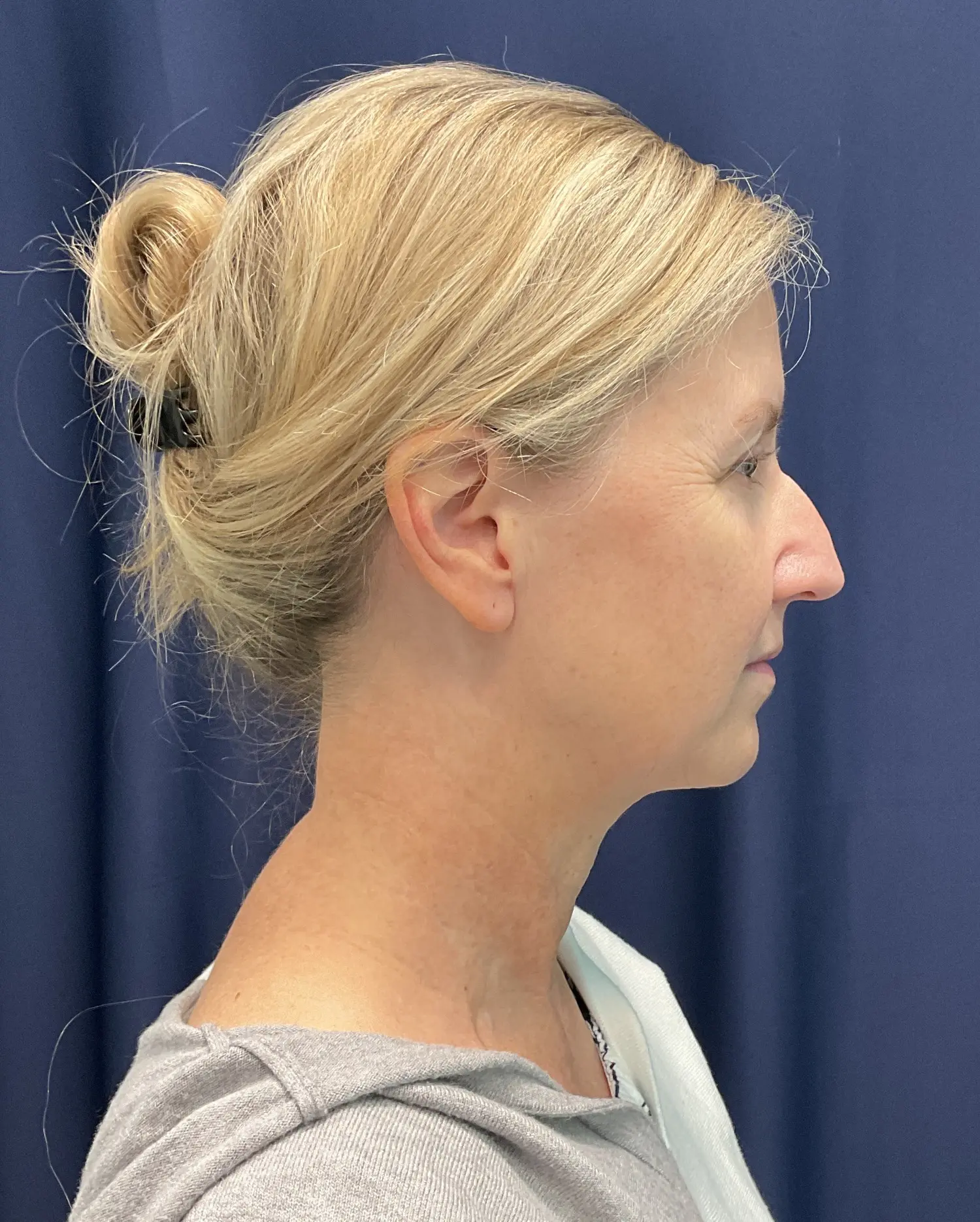 Eyelid Surgery Patient Photo - Case 5831 - before view-2