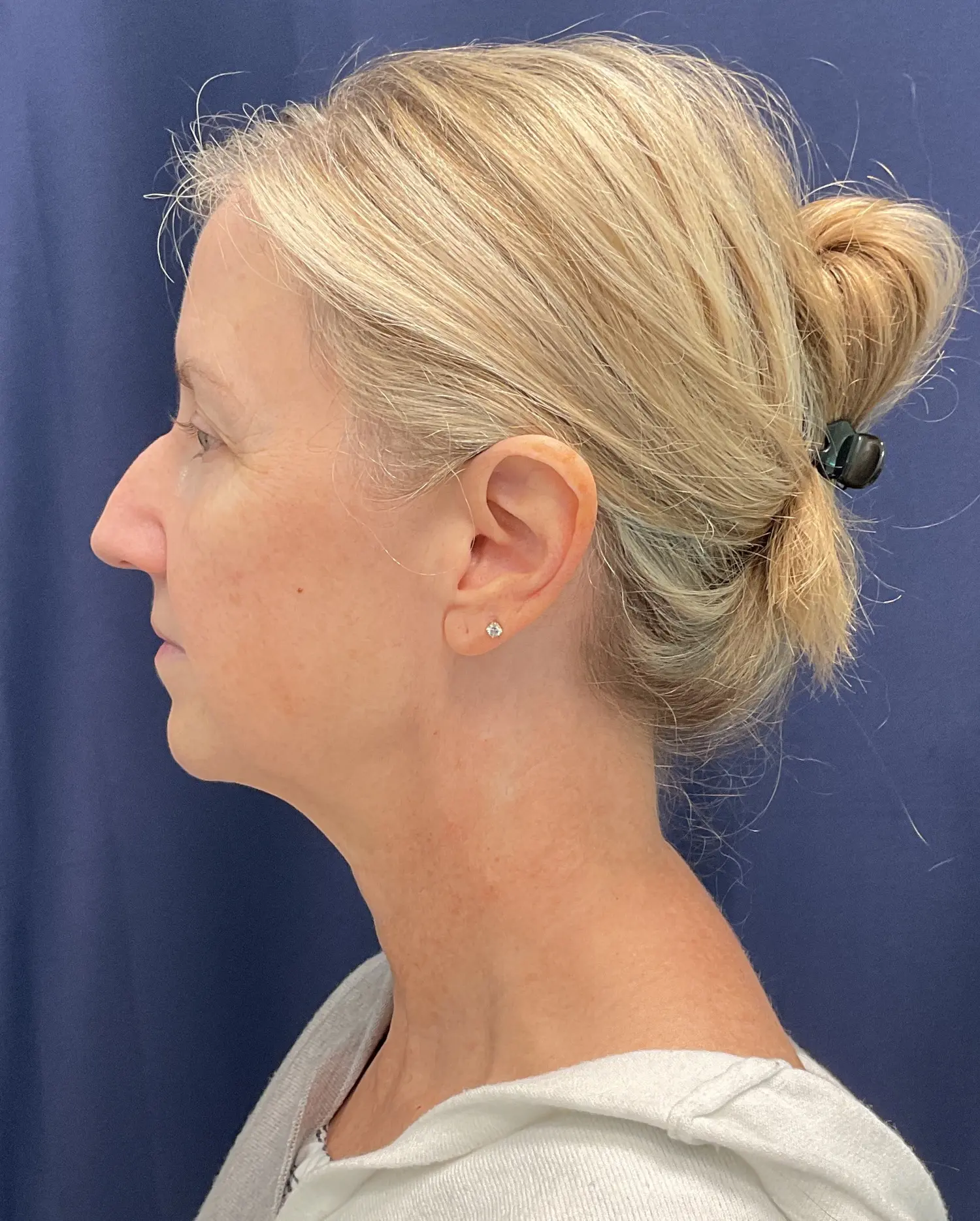 Eyelid Surgery Patient Photo - Case 5831 - before view-4