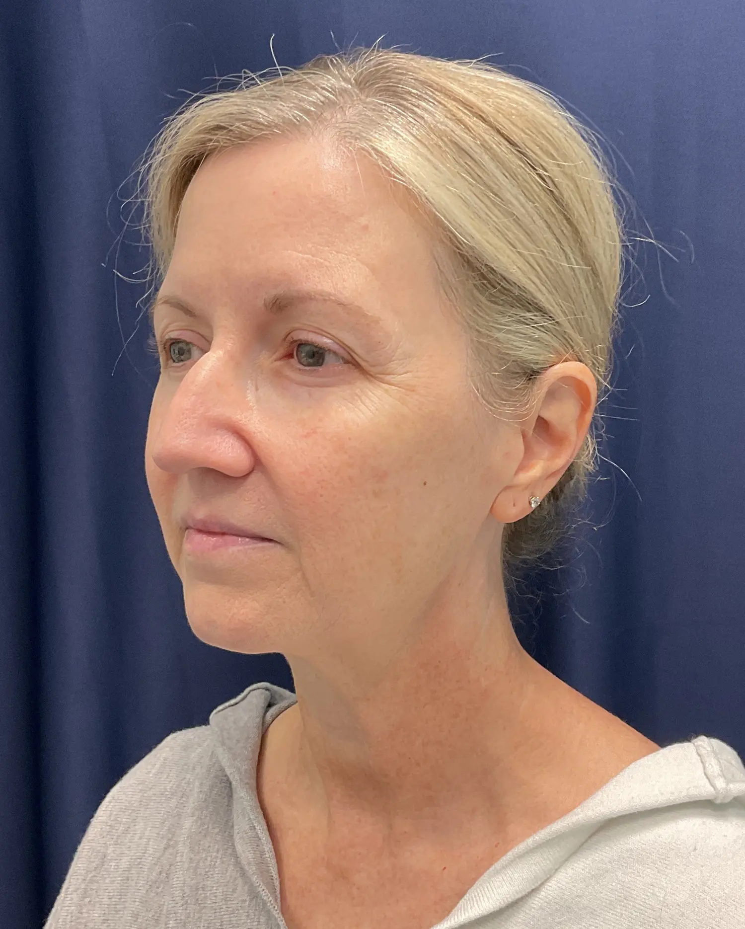 Eyelid Surgery Patient Photo - Case 5831 - before view-3