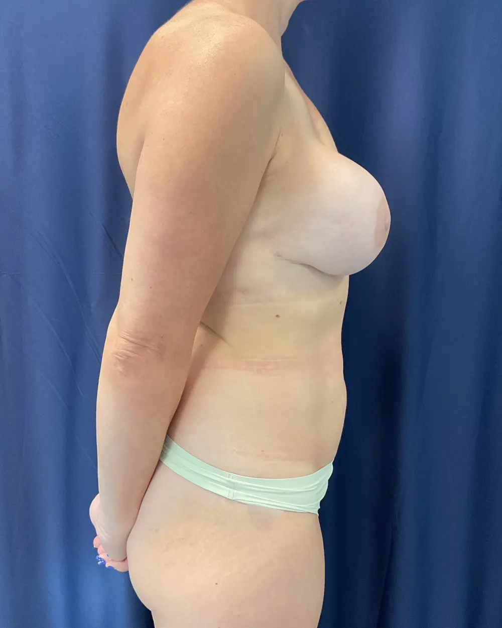 Abdominoplasty Patient Photo - Case 5957 - before view-4