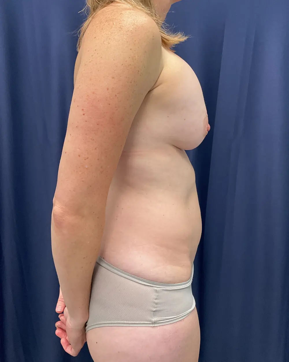 Abdominoplasty Patient Photo - Case 6007 - before view-4