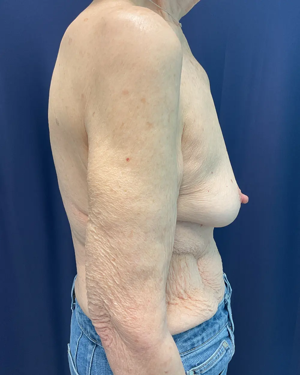 Breast Augmentation Patient Photo - Case 6253 - before view-4