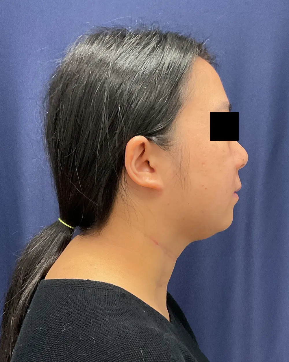 Facial Contouring Patient Photo - Case 6218 - before view-2