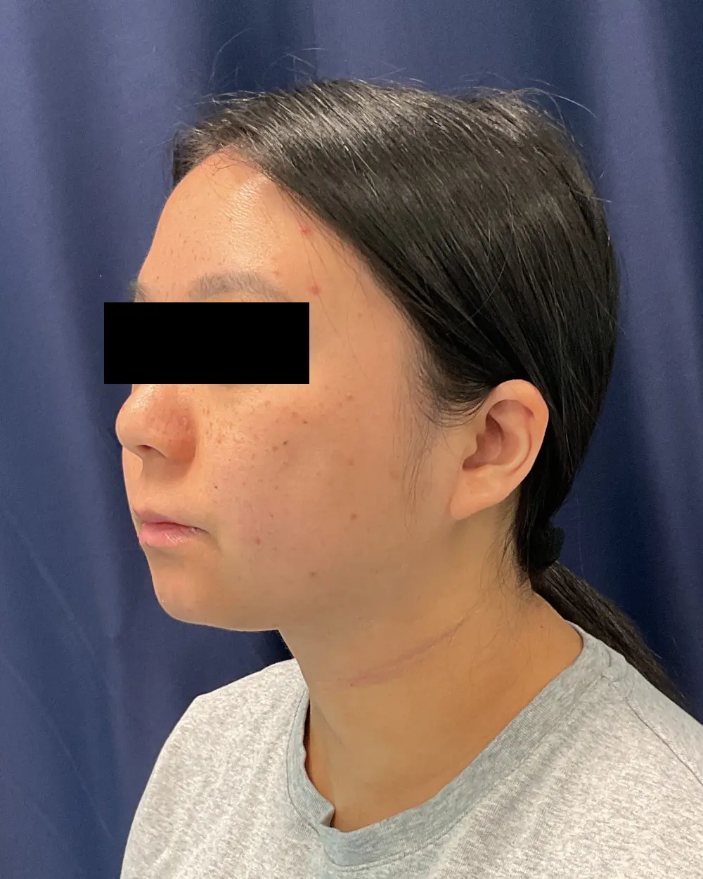 Facial Contouring Patient Photo - Case 6218 - after view-3