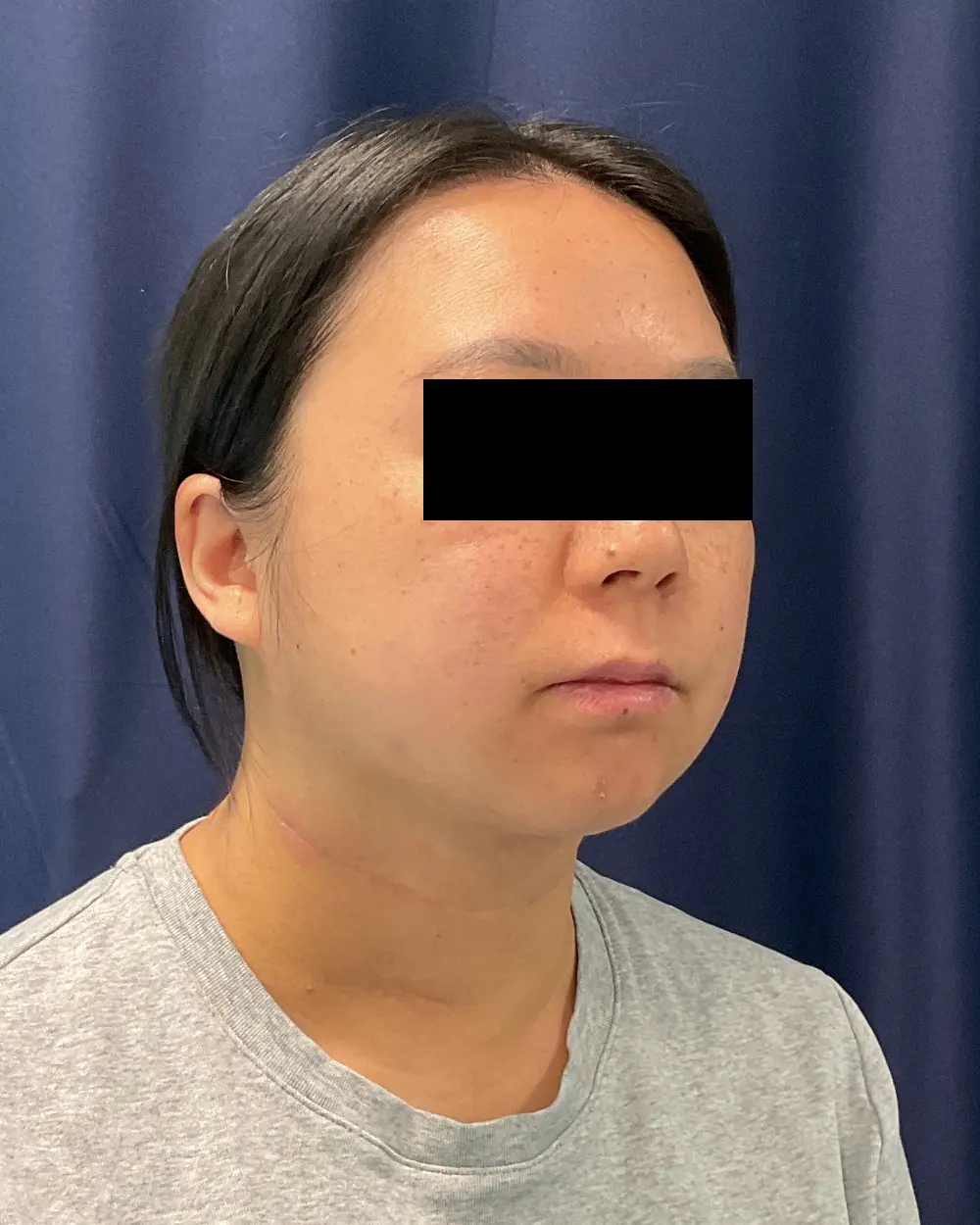 Facial Contouring Patient Photo - Case 6218 - after view-1