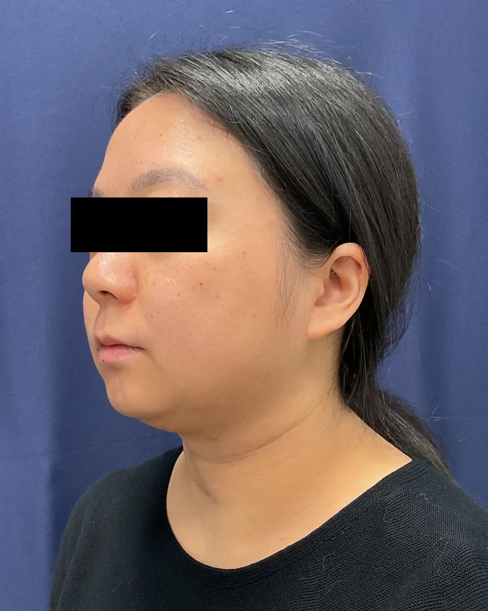 Facial Contouring Patient Photo - Case 6218 - before view-3