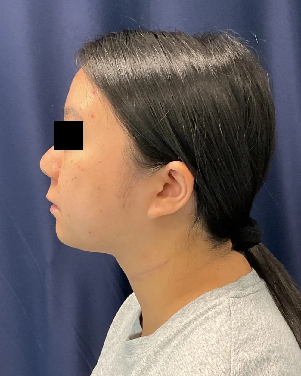 Facial Contouring Patient Photo - Case 6218 - after view-4