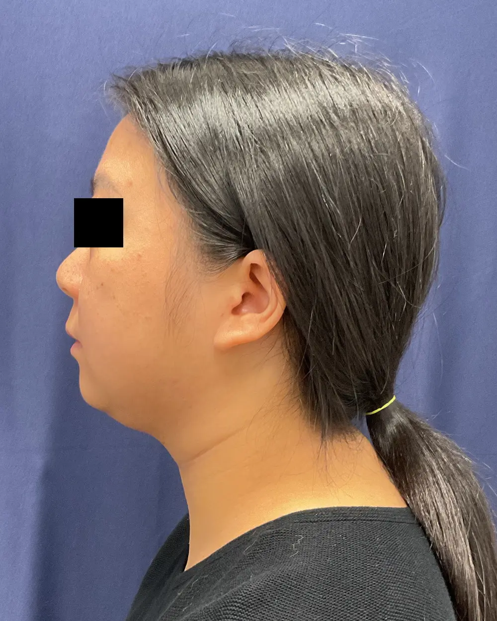 Facial Contouring Patient Photo - Case 6218 - before view-4