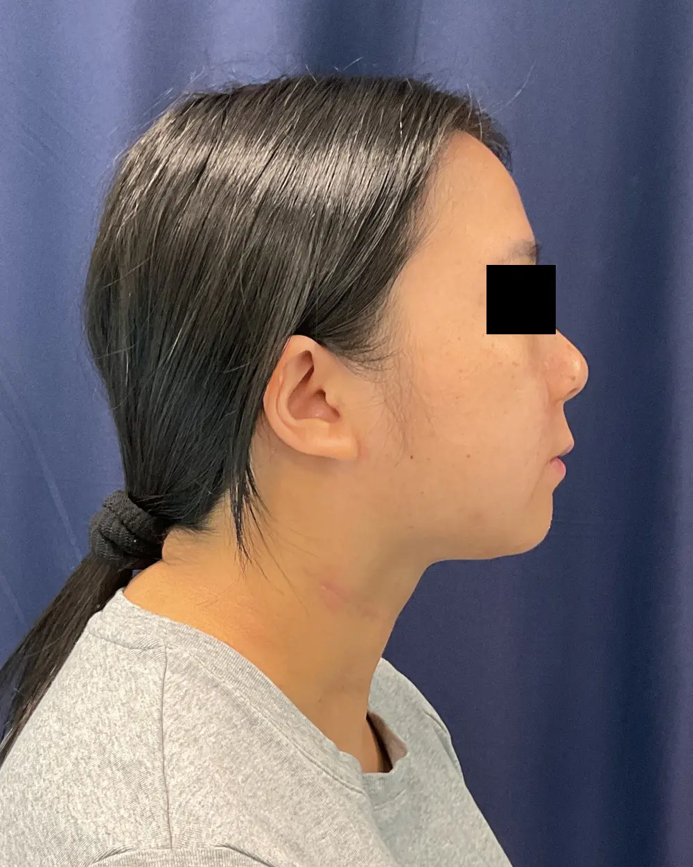 Facial Contouring Patient Photo - Case 6218 - after view-2