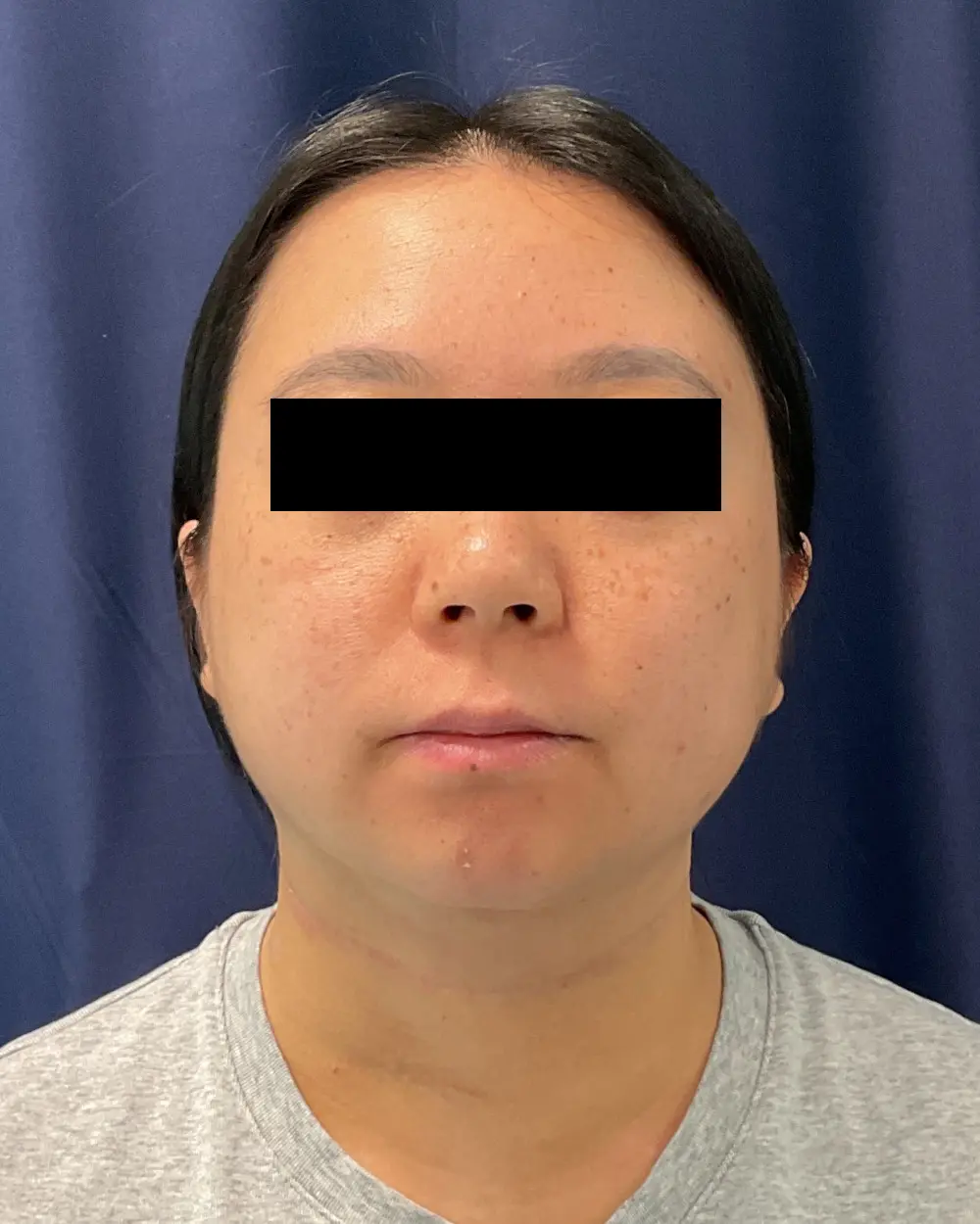 Facial Contouring Patient Photo - Case 6218 - after view