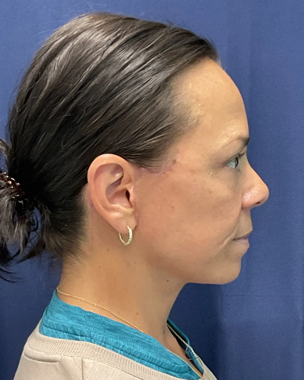 Eyelid Surgery Patient Photo - Case 6489 - after view-1