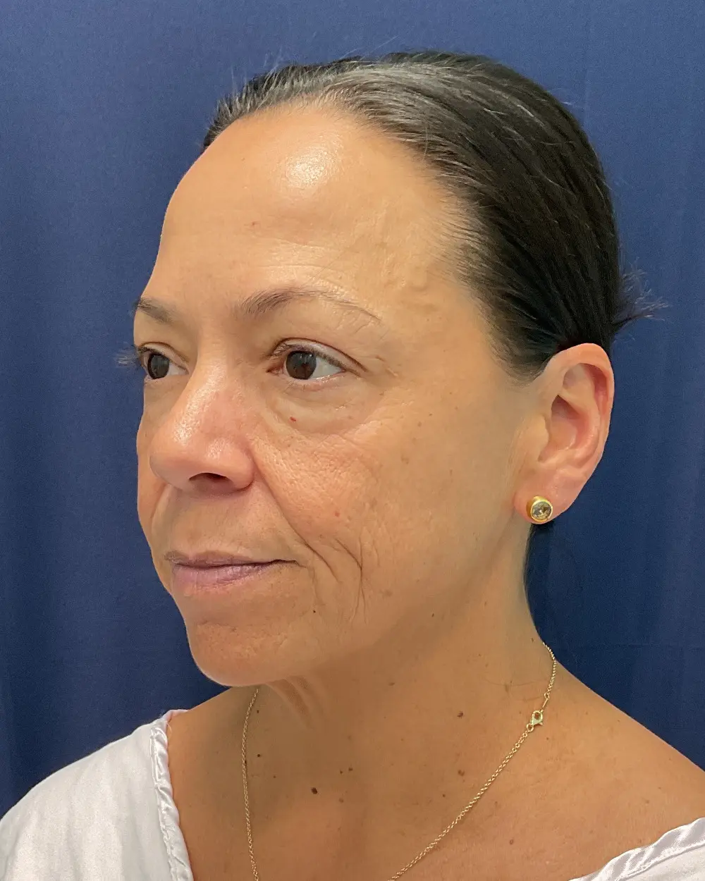 Eyelid Surgery Patient Photo - Case 6489 - before view-4