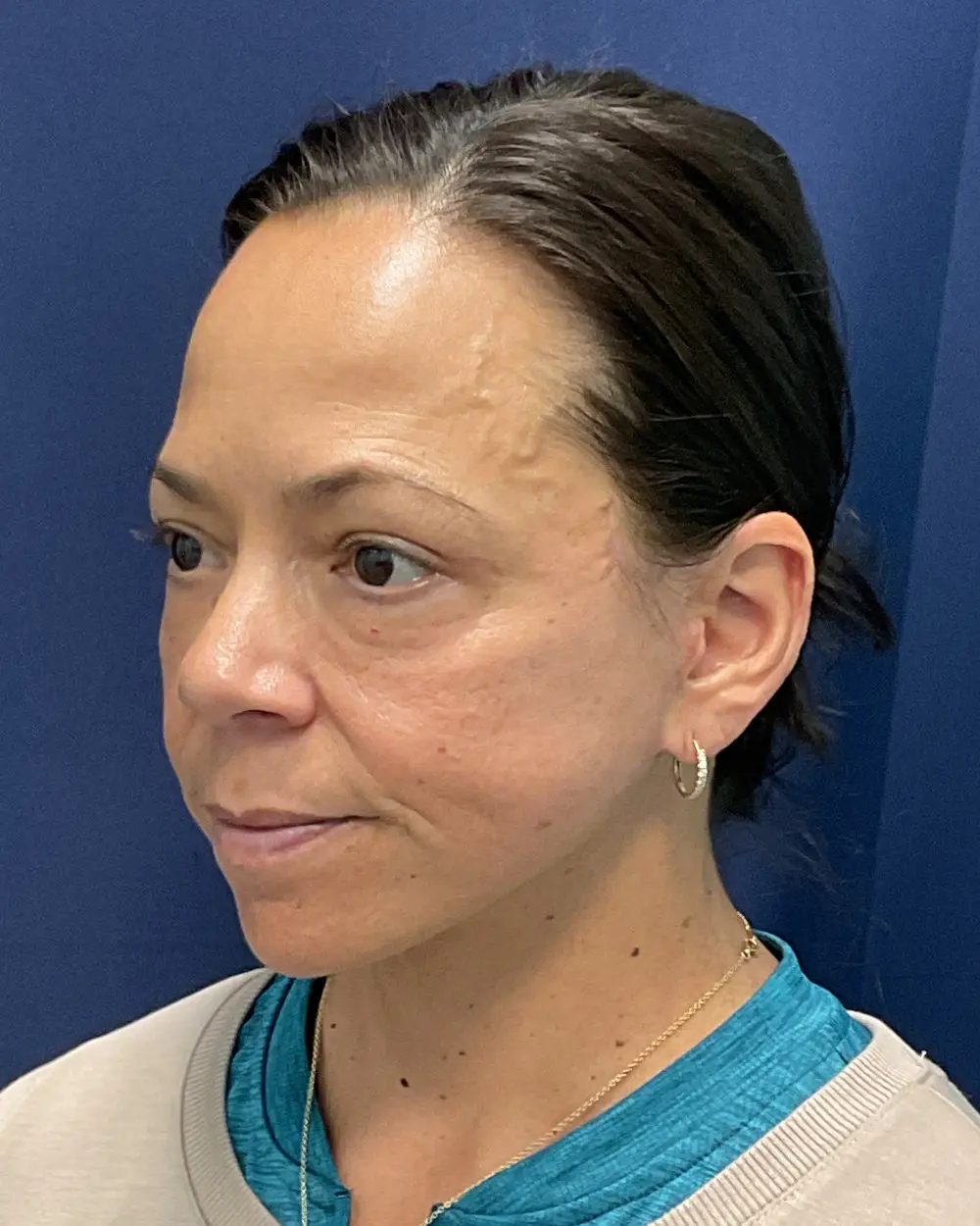 Eyelid Surgery Patient Photo - Case 6489 - after view-4