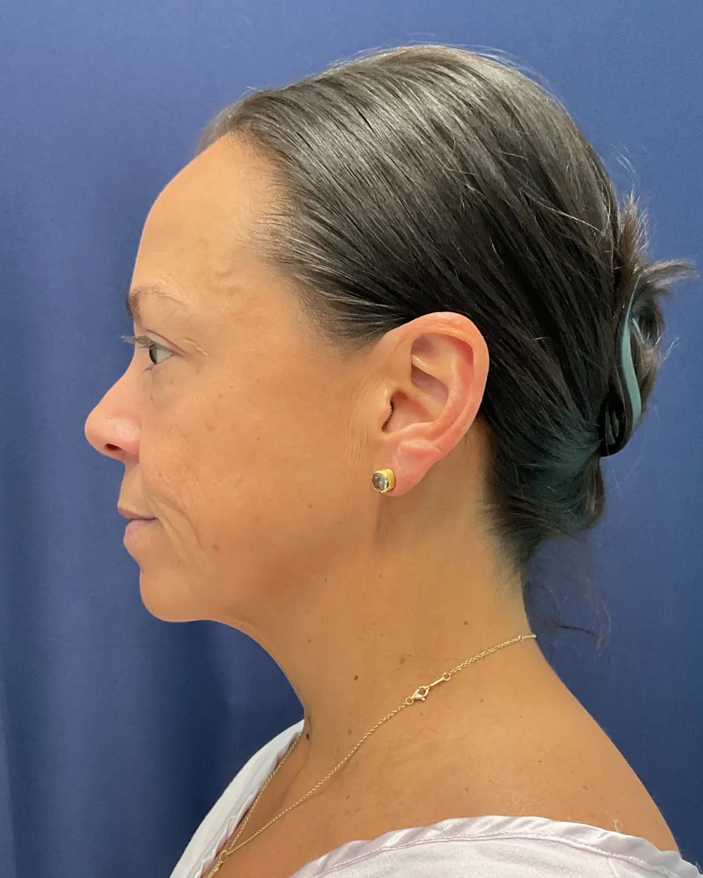 Eyelid Surgery Patient Photo - Case 6489 - before view-3