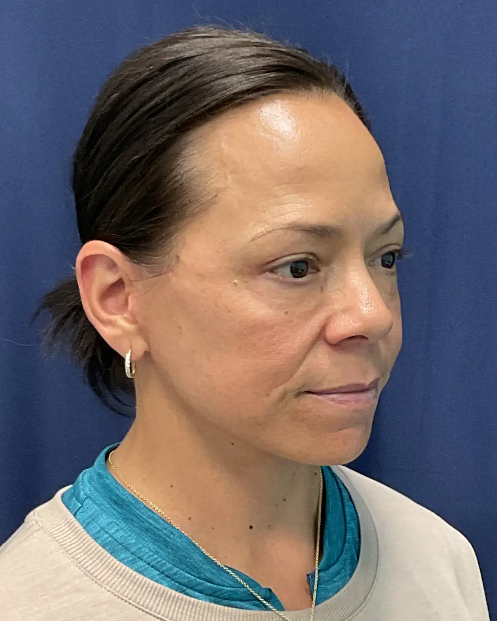 Eyelid Surgery Patient Photo - Case 6489 - after view-2