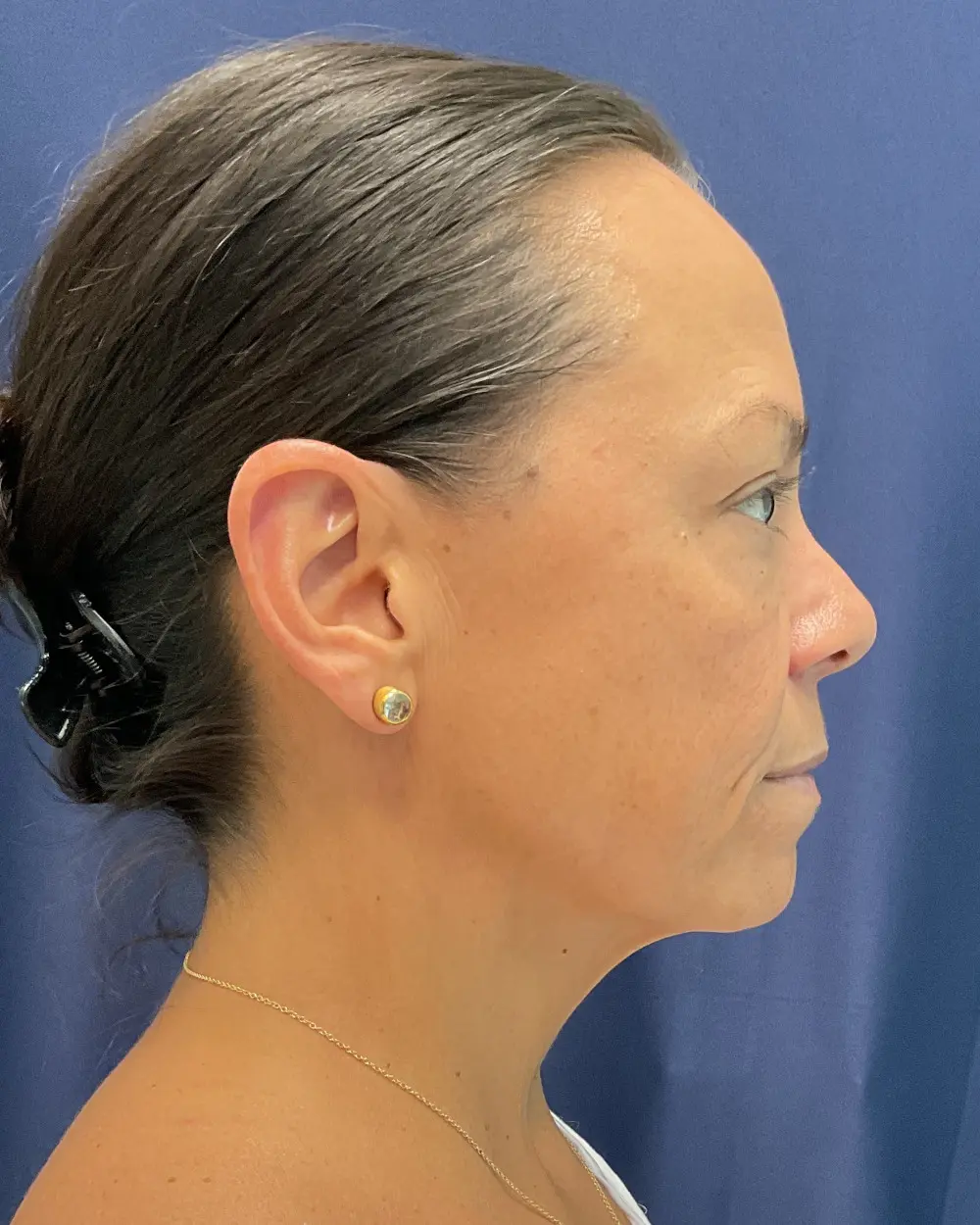 Eyelid Surgery Patient Photo - Case 6489 - before view-1