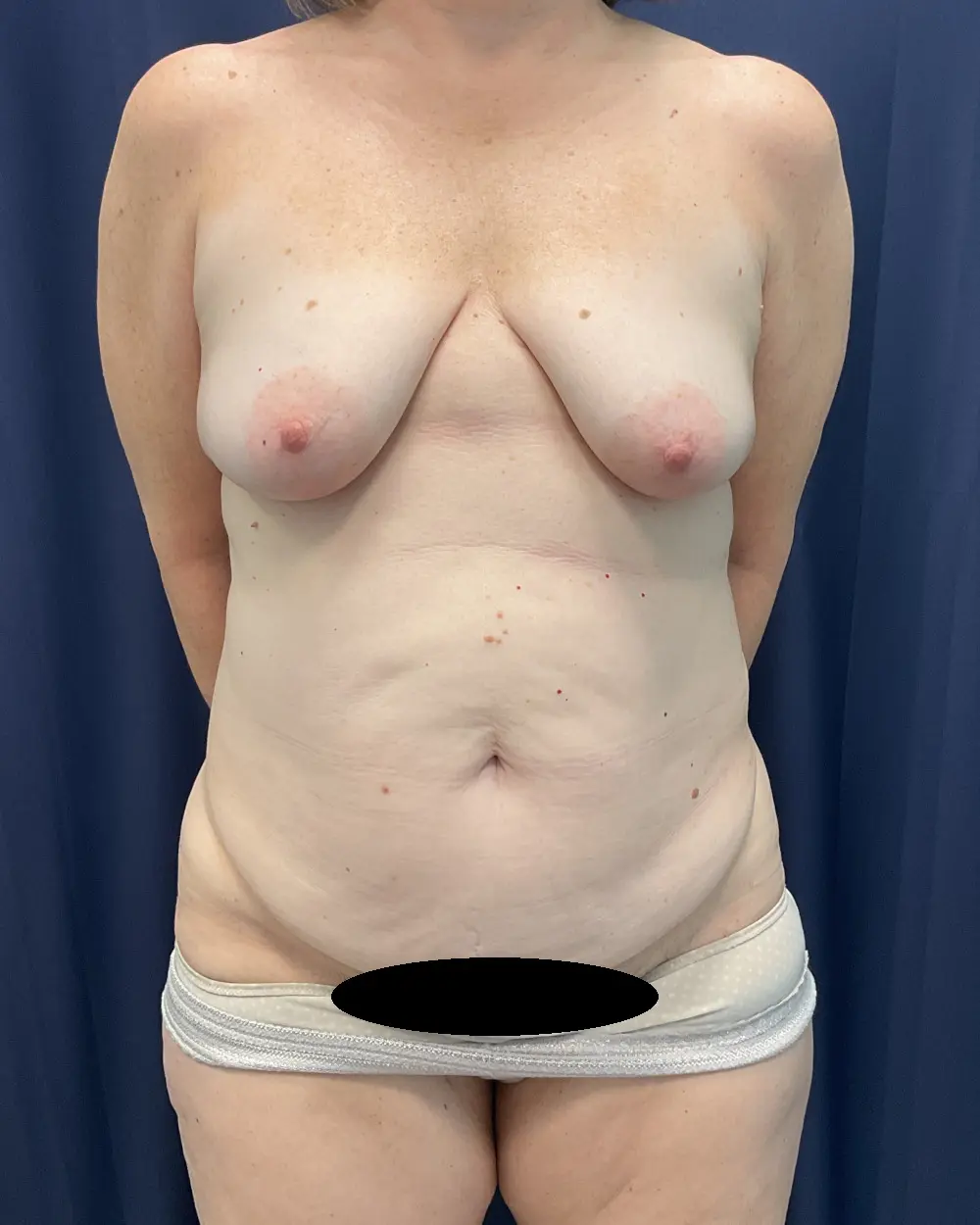 Abdominoplasty Patient Photo - Case 6511 - before view-