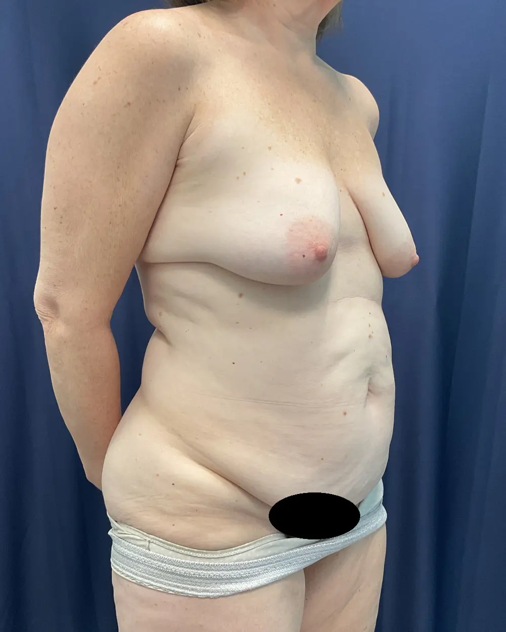 Abdominoplasty Patient Photo - Case 6511 - before view-3