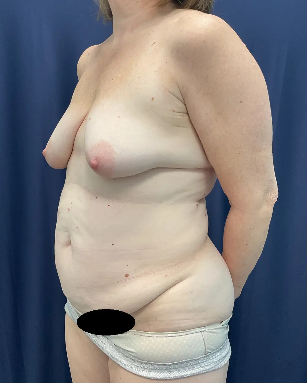 Abdominoplasty Patient Photo - Case 6511 - before view-1