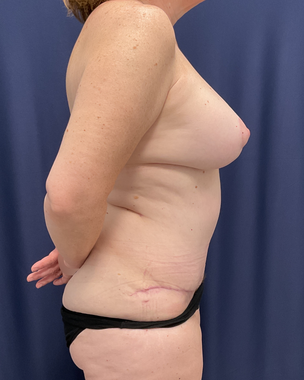 Abdominoplasty Patient Photo - Case 6511 - after view-4