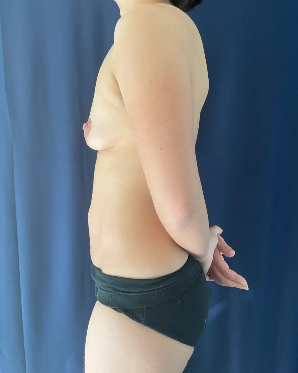 Abdominoplasty Patient Photo - Case 6528 - before view-2