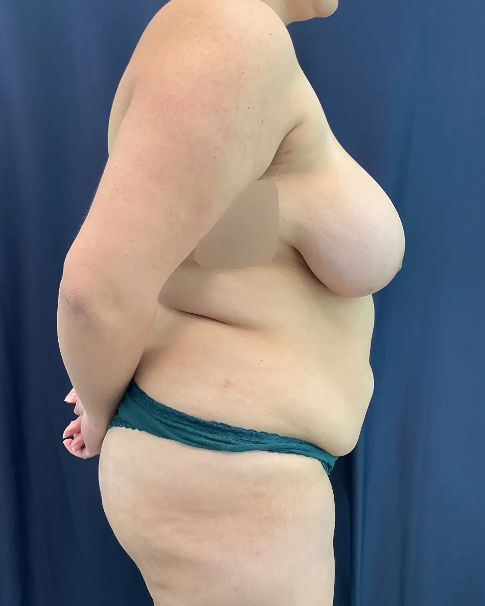 Breast Reduction Patient Photo - Case 6565 - before view-4