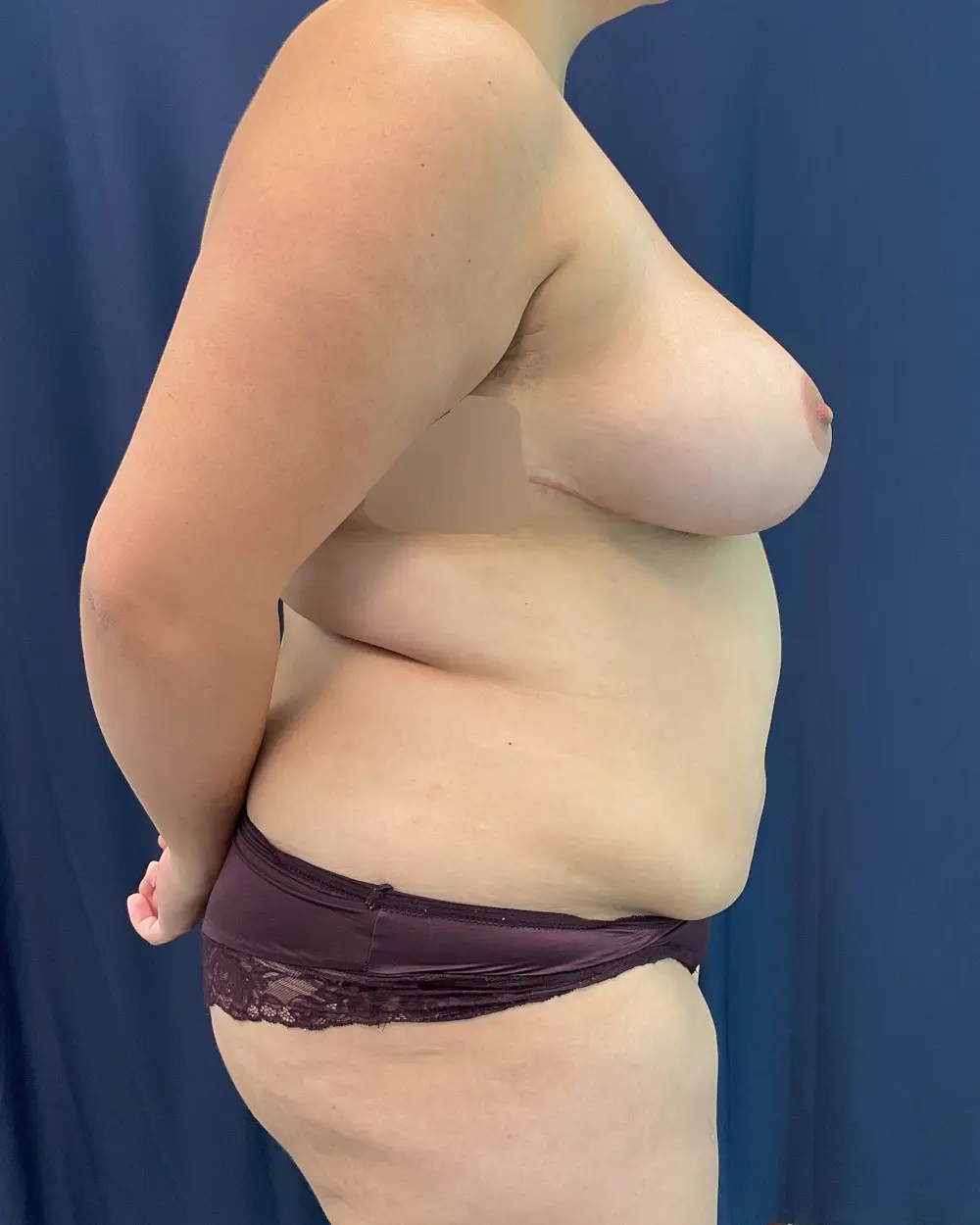 Breast Reduction Patient Photo - Case 6565 - after view-4
