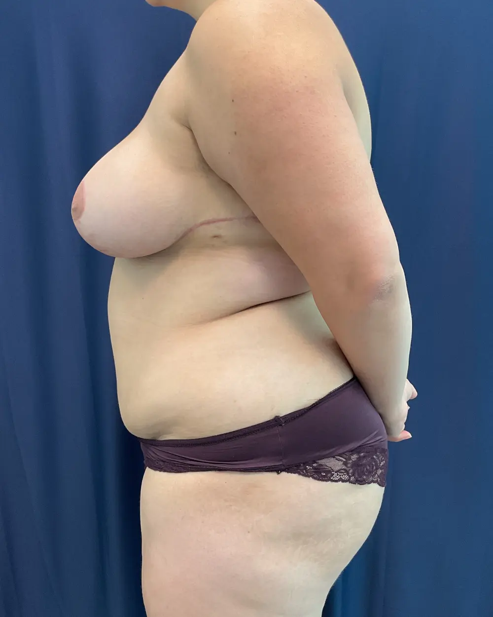 Breast Reduction Patient Photo - Case 6565 - after view-2