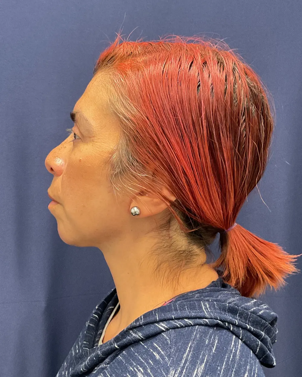 Eyelid Surgery Patient Photo - Case 6656 - after view-4