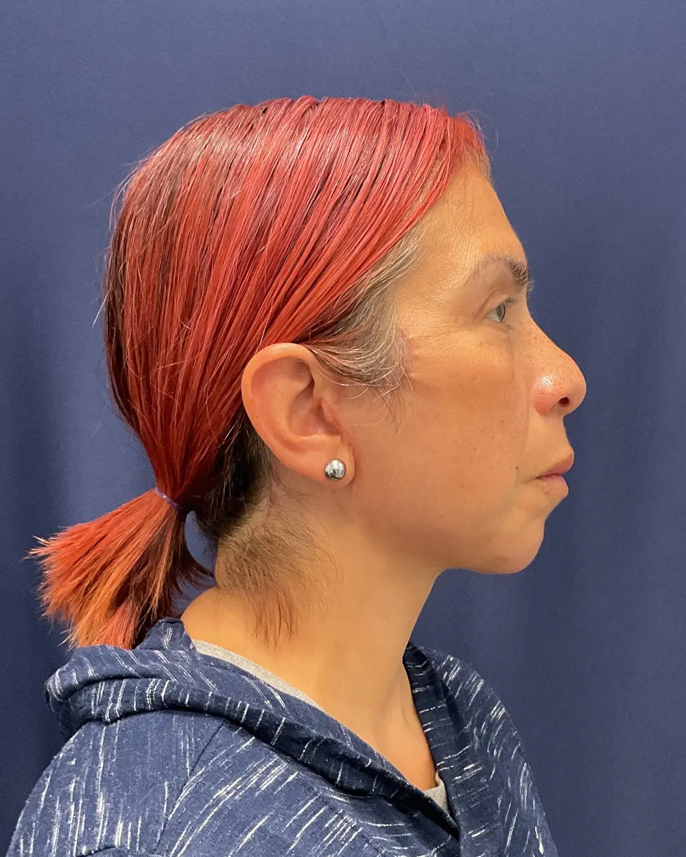Eyelid Surgery Patient Photo - Case 6656 - after view-2