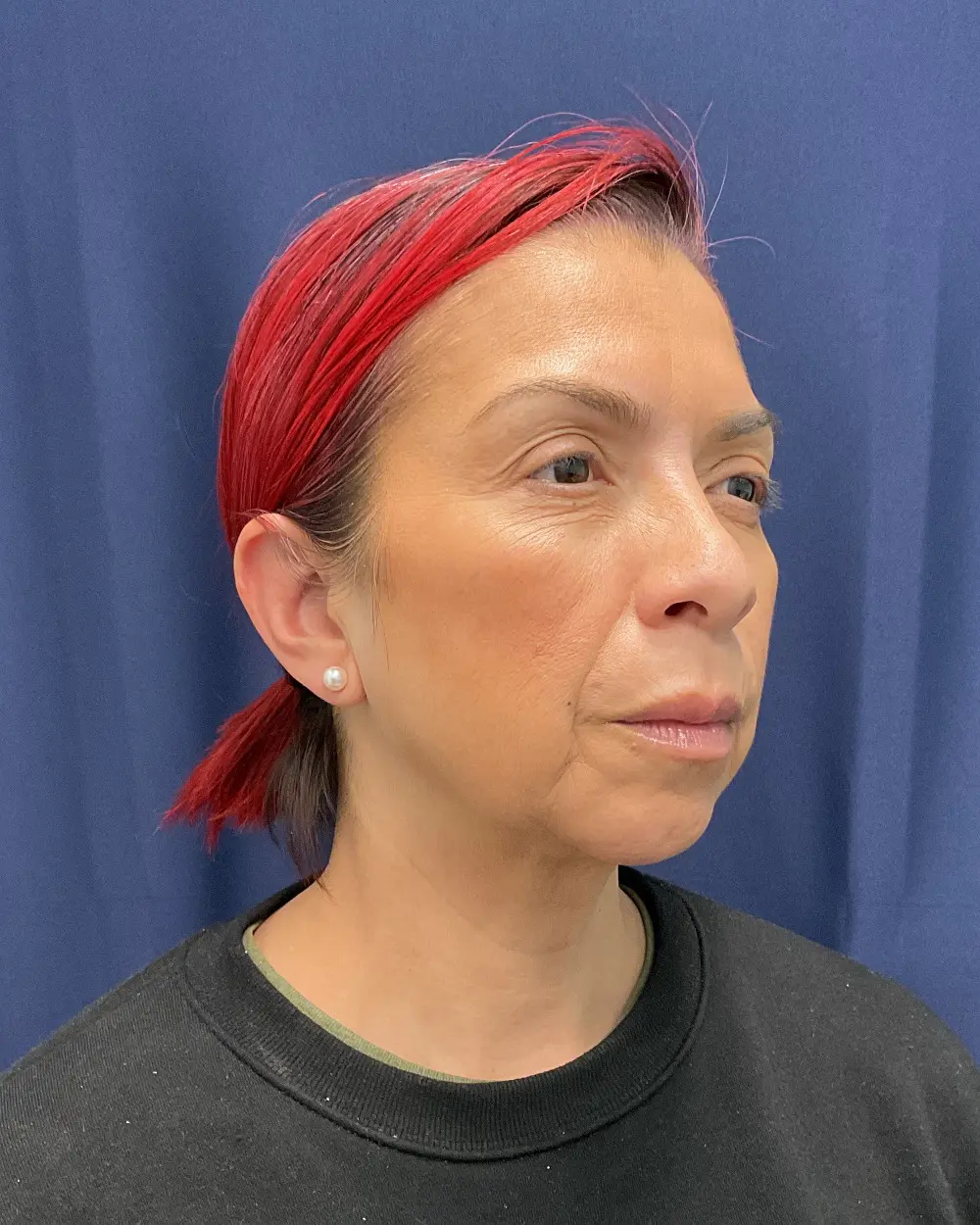Eyelid Surgery Patient Photo - Case 6656 - before view-1