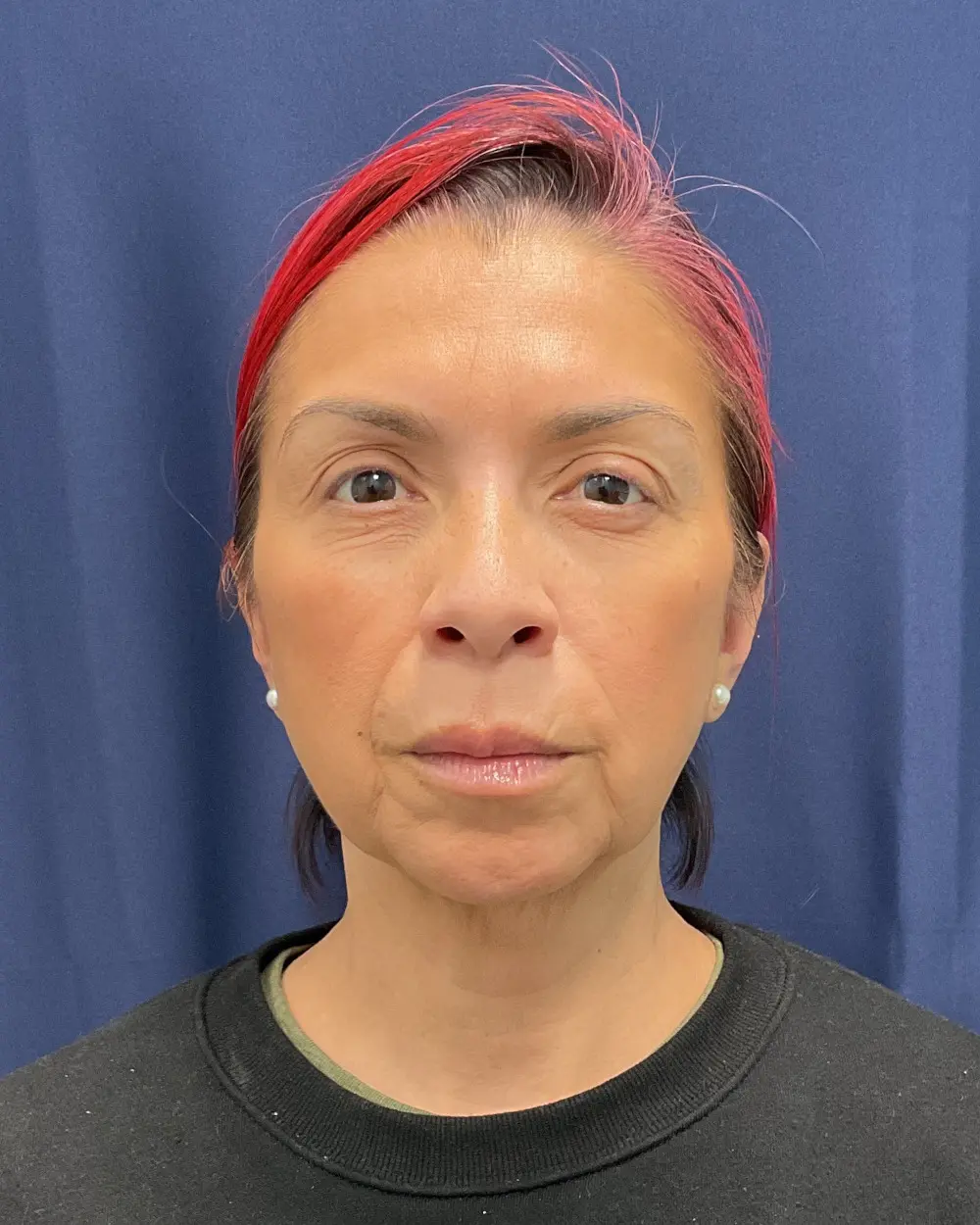 Eyelid Surgery Patient Photo - Case 6656 - before view-