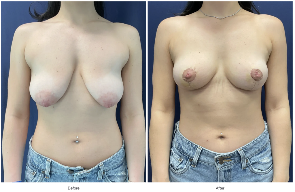 breast lift before and after 3