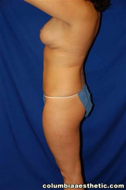Breast Lift Patient Photo - Case 1 - after view-1