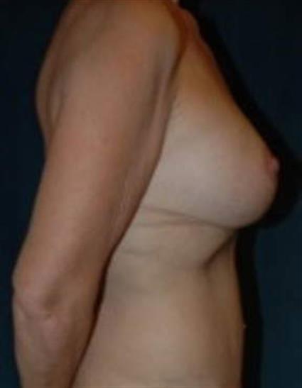 Breast Augmentation Patient Photo - Case 10 - after view-1