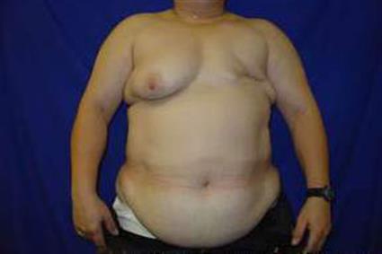 Breast Reconstruction Patient Photo - Case 11 - before view-
