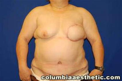Breast Reconstruction Patient Photo - Case 11 - after view-0