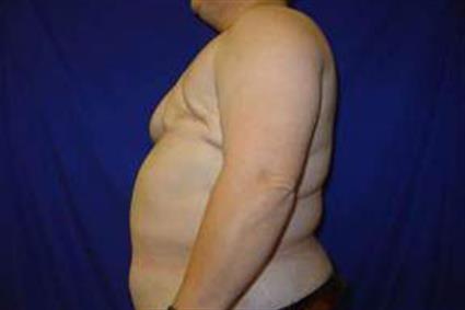 Breast Reconstruction Patient Photo - Case 11 - before view-1