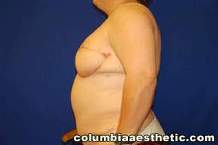 Breast Reconstruction Patient Photo - Case 11 - after view-1