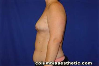 Breast Reconstruction Patient Photo - Case 14 - before view-1