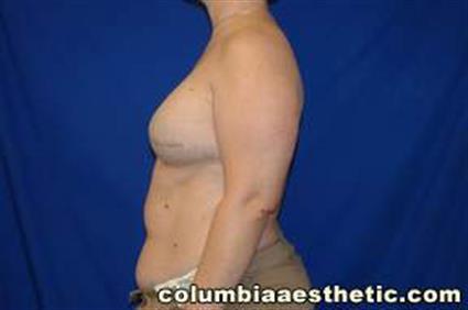 Breast Reconstruction Patient Photo - Case 14 - after view-1