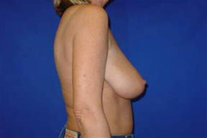Breast Reduction Patient Photo - Case 15 - before view-2