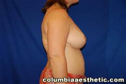 Breast Reduction Patient Photo - Case 16 - after view-2